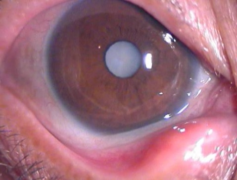 為什么會得白內障眼病?