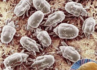 個(gè)人衛(wèi)生差，螨蟲(chóng)會(huì)寄宿眼部得蠕形螨瞼緣炎