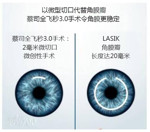 近視手術有哪幾種？你適合那種快看看