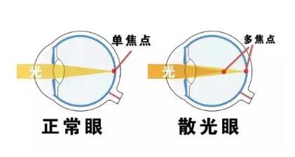 近視和散光,手術能同時矯正嗎?